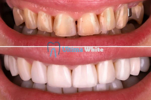 What Makes Instant Teeth Whitening Treatments So Popular Royal Tunbridge Wells?